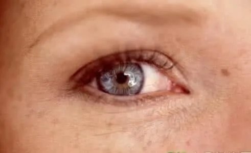 去黄褐斑大概要多少钱